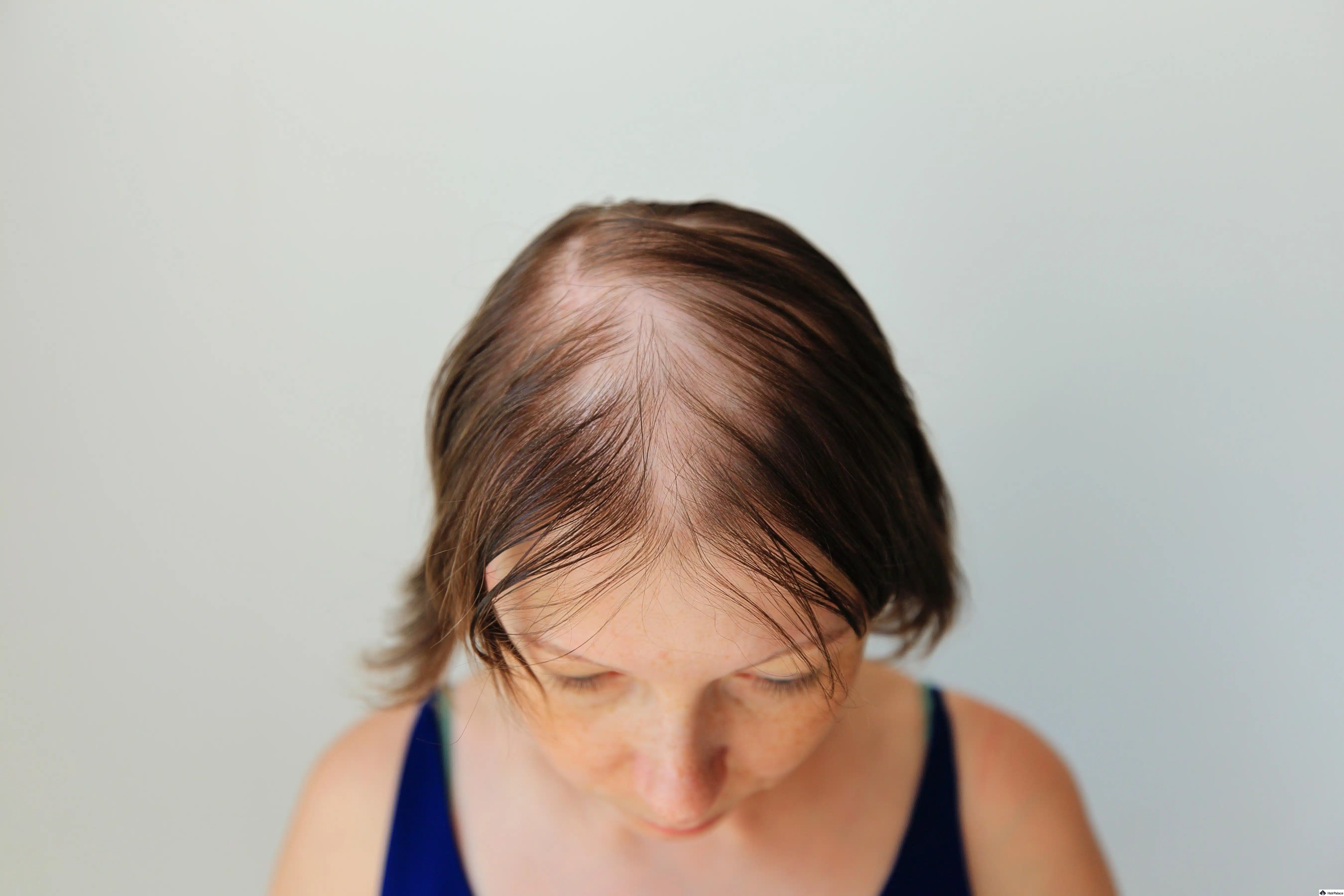 Example of diffuse hair shedding across the scalp