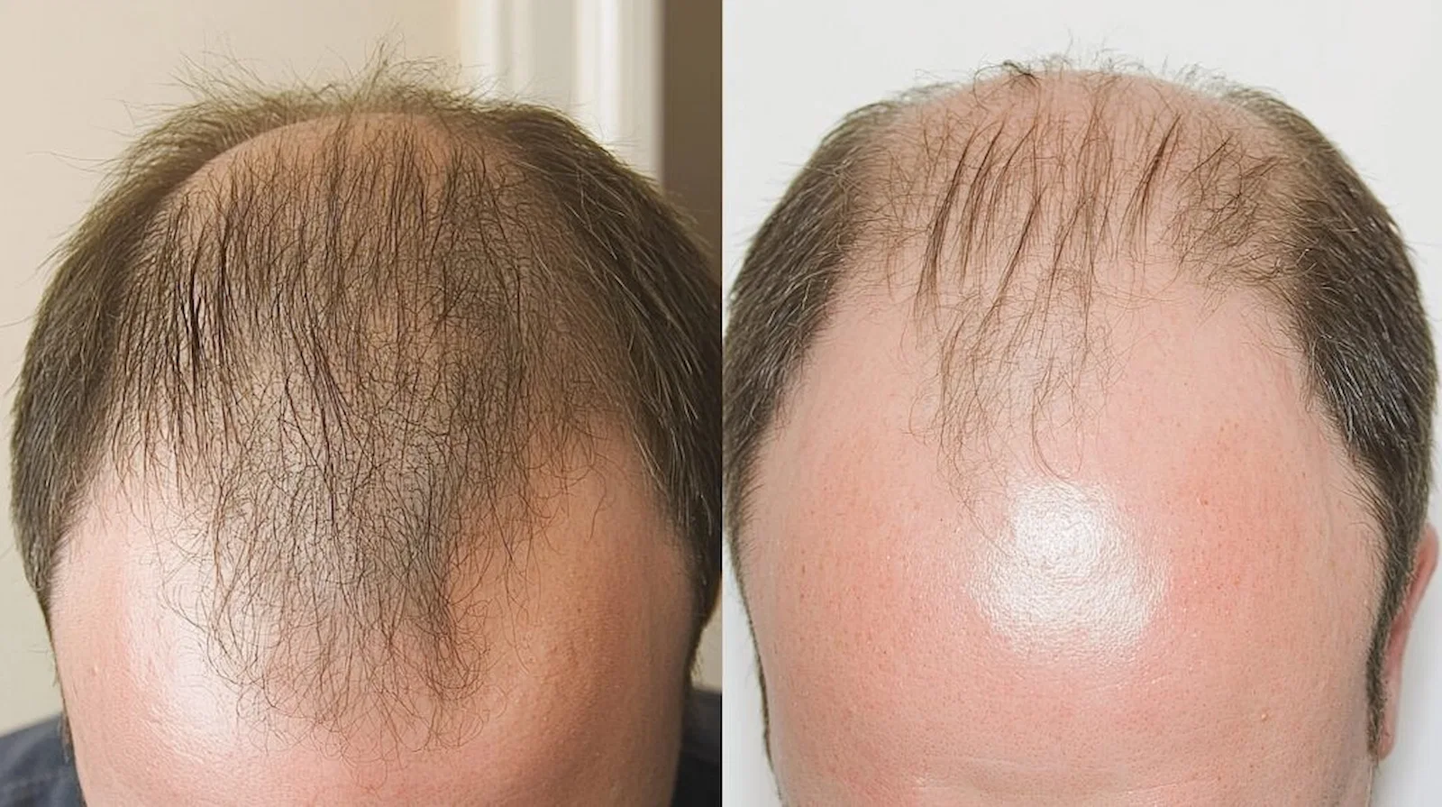 Example of pattern hair loss