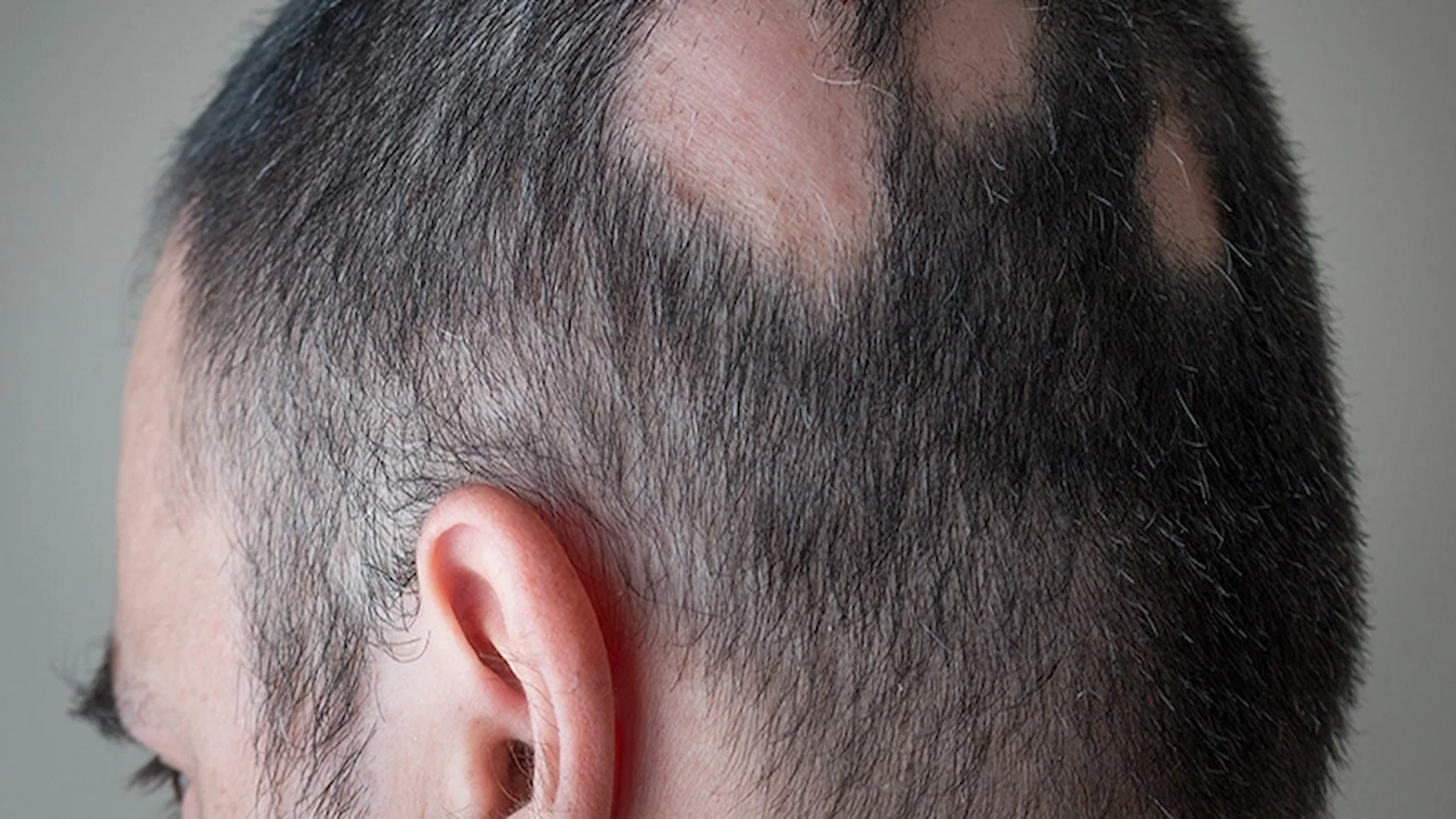 Example of scarring and inflammatory alopecia